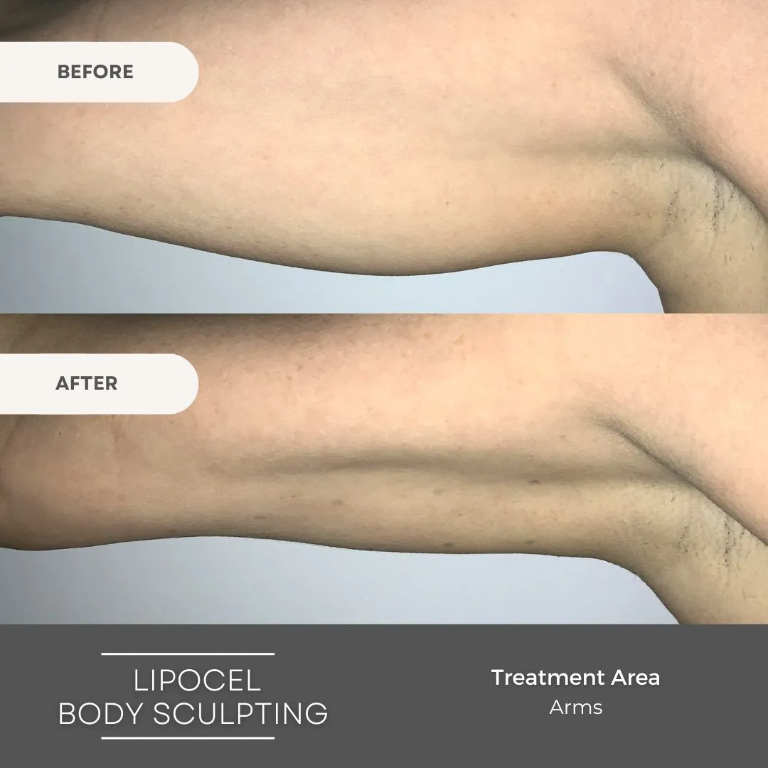 Body Sculpting Clinics Bondi Junction