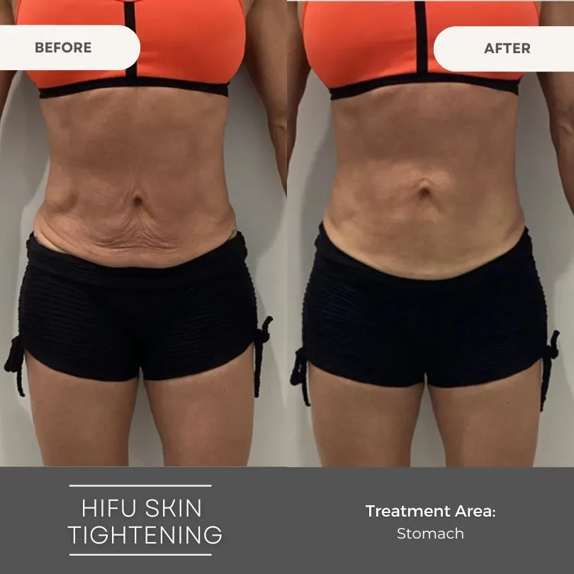 Body Sculpting Clinics Bondi Junction